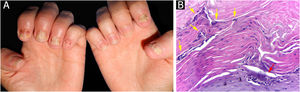 Nail psoriasis ‒ (A) Regular onycholysis on all fingernails, some with oil spots, subungual hyperkeratosis, and total dystrophy; (B) Neutrophilis exudate amidst superficial keratinocytes (red arrow); neutrophils within parakeratotic scale (yellow arrows). Hematoxilina & eosin, ×400.