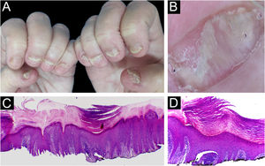 Lichen planus ‒ (A) All fingernails affected: regular onycholysis, subungual hyperkeratosis and onychodystrophy; (B) Onychoscopy: red spots on the lunula, subungual hyperkeratosis and irregular striated leukonychia; (C) Nail bed with significant lymphoid infiltrate within the dermal papillae; (D) lichenoid lymphoid infiltrate fills the papilla, with a subepidermal cleft. Hematoxilina & eosin, ×100 (C) and × 400 (D).