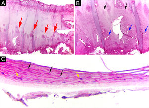 Psoriasis (nail plate) ‒ (A) Papillomatosis (the tops of the papillae superficialized from the bed – red arrows); (B) Intracorneal serous exudate on the top of the papillae (blue arrows), with parakeratosis (black arrows); (C) Keratinocyte nuclei (parakeratosis ‒ black arrows) and rare neutrophils (yellow arrows). Hematoxilina & eosin, ×100 (A, B) and ×400 (C).