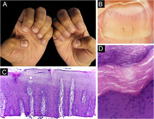 Nail psoriasis ‒ (A) All fingernails with regular onycholysis, salmon patch, some oil spots, subungual hyperkeratosis and splinter hemorrhages; (B) Onychoscopy: distal leukonychia and splinter hemorrhages; (C) High papillae vascular density; (D) Area of hypogranulosis, on the left, and area of hypergranulosis, on the right. Hematoxilina & eosin ×100 (C) and ×400 (D).