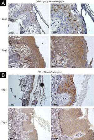 IHC images with Dsg1 and Dsg3 expression stained with DAB in paraffin sections from bullous lesion biopsies showing superficial acantholysis. (A) Control sample from the PF-anti-Dsg3(-) group. Observe Dsg1 expression in intracytoplasmic clumps, and Dsg3 expression throughout the epidermis. (B) Sample from patient PF8 in the anti-Dsg3+ group. The Dsg1 and Dsg3 expressions are similar to those of the PF control.