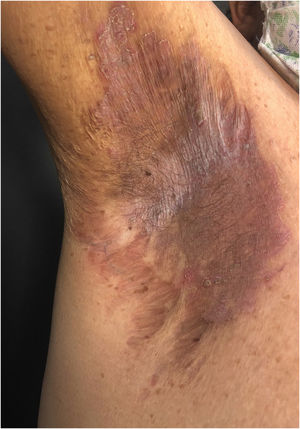 Classic involvement in Hailey-Hailey disease: vesico-pustular and eroded circinate lesion with central hyperchromia in the axillary region.