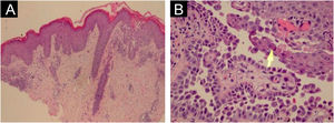 (A) Suprabasal acantholytic dyskeratosis in the epidermis that does not affect the follicular epithelium (Hematoxylin & eosin, ×20); (B) Detail of acantholysis (arrow) (Hematoxylin & eosin, ×100).