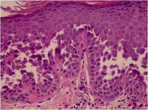 Presence of acantholytic cells filling the cavity and giving the appearance of a dilapidated brick wall (Hematoxylin & eosin, ×400).