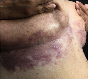 Macerated violaceous plaque with discrete lichenification in the inframammary region.