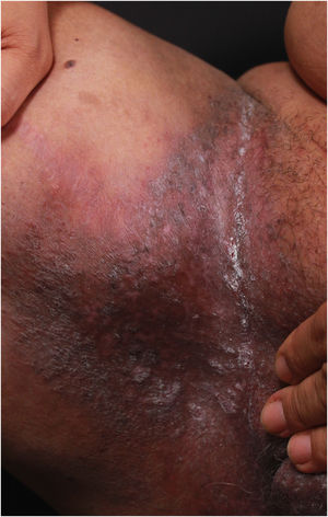 Hyperchromic plaque with lichenified edges and hyperchromic center in the inguinal region.