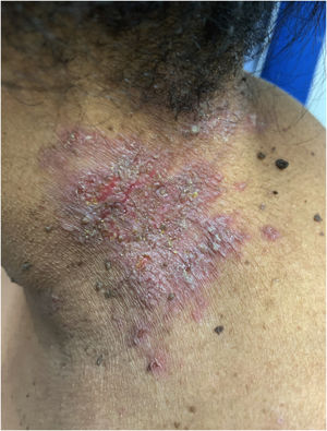 Grouped vesico-pustules with erythema, linear erosions and meliceric crusts in the cervical region.