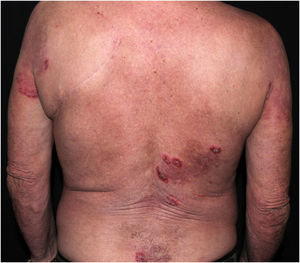 Circinate erythematous plaques with peripheral vesicles, erosions and desquamation on the back and arms.