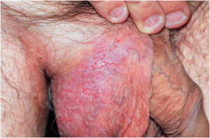 Other clinical manifestations of Hailey-Hailey disease: (A) verrucous plaque with linear erosions in the scrotal region. Also note the leukonychia striata.