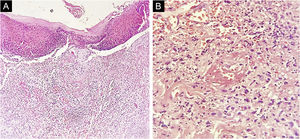 (A) Ulceration with entire epidermal necrosis (Hematoxylin & eosin, ×100). (B) Close-up view of the intense inflammatory infiltrate of neutrophils and lymphocytes with vasculitis through the dermis (Hematoxylin & eosin, ×400).