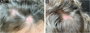 Rounded erythematous plaques of alopecia on the frontal and right parietal regions (A) and on the vertex of the scalp (B).