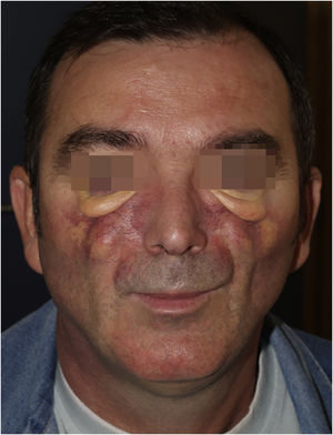 Physical appearance 2010: cutaneous facial thickening and progressive facial deformity, exophthalmos with yellow-orange skin, large telangiectasias and lower eyelid big bags.