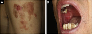 (A) Crusted plaque and erythema at the vaccination site on the left upper arm. (B) Erosions of the oral mucosa.