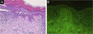 (A) Histopathological findings showing acantholysis within the lower epidermal layers, and the presence of dense lymphocytic and eosinophilic dermal infiltrates (×40). (B) Direct immunofluorescence revealed intercellular deposition of IgG in the epidermal cells (×40).