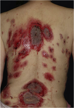 Extensive erythema, flaccid blisters and post-bullous erosions on the trunk.
