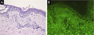 (A) Histopathological findings showing acantholysis within the lower epidermal layers, and the presence of dense lymphocytic and neutrophilic dermal infiltrates (×40). (B) Direct immunofluorescence revealed intercellular deposition of IgG in the lower epidermal cells (×40).