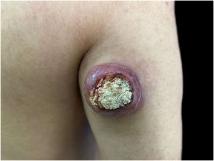 Tumor measuring approximately 6×5 cm in diameter, on the posterolateral region of the right arm.