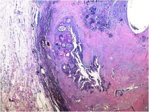 Giant pilomatricoma: well-defined proliferation, with expansive growth, adjacent to subcutaneous adipose tissue (Hematoxylin & eosin, ×200).