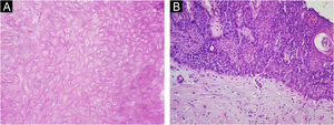 Histopathology depicting typical pilomatricoma findings such as “ghost cells” (A) and basophilic matrix cells (B) the right (Hematoxylin & eosin, ×400).
