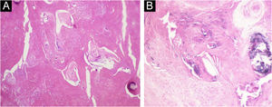 Osseous matrix foci and dystrophic calcification amid compact keratin (Hematoxylin & eosin, ×200).