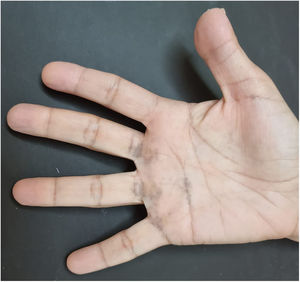 Palmar lines at the base of the 3rd, 4th and 5th fingers: greyish-brown spots with a lacy appearance.