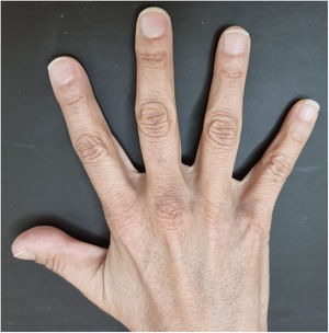 Dorsum of the hand ‒ between the bases of the 3rd, 4th and 5th fingers: grayish-brown spots.