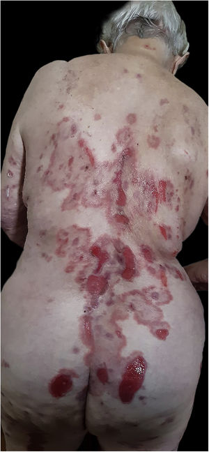 Erosions on the trunk and buttocks.