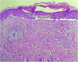 Hematoxylin & eosin, 100x. Revealing subepidermal blister formation with eosinophilic infiltrate.