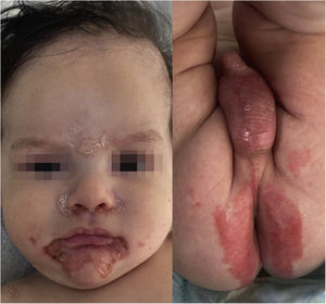 Erythematous-desquamative lesions in the perioral, perinasal, glabella and genital regions.