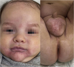 Three weeks after zinc supplementation, the patient showed significant improvement.