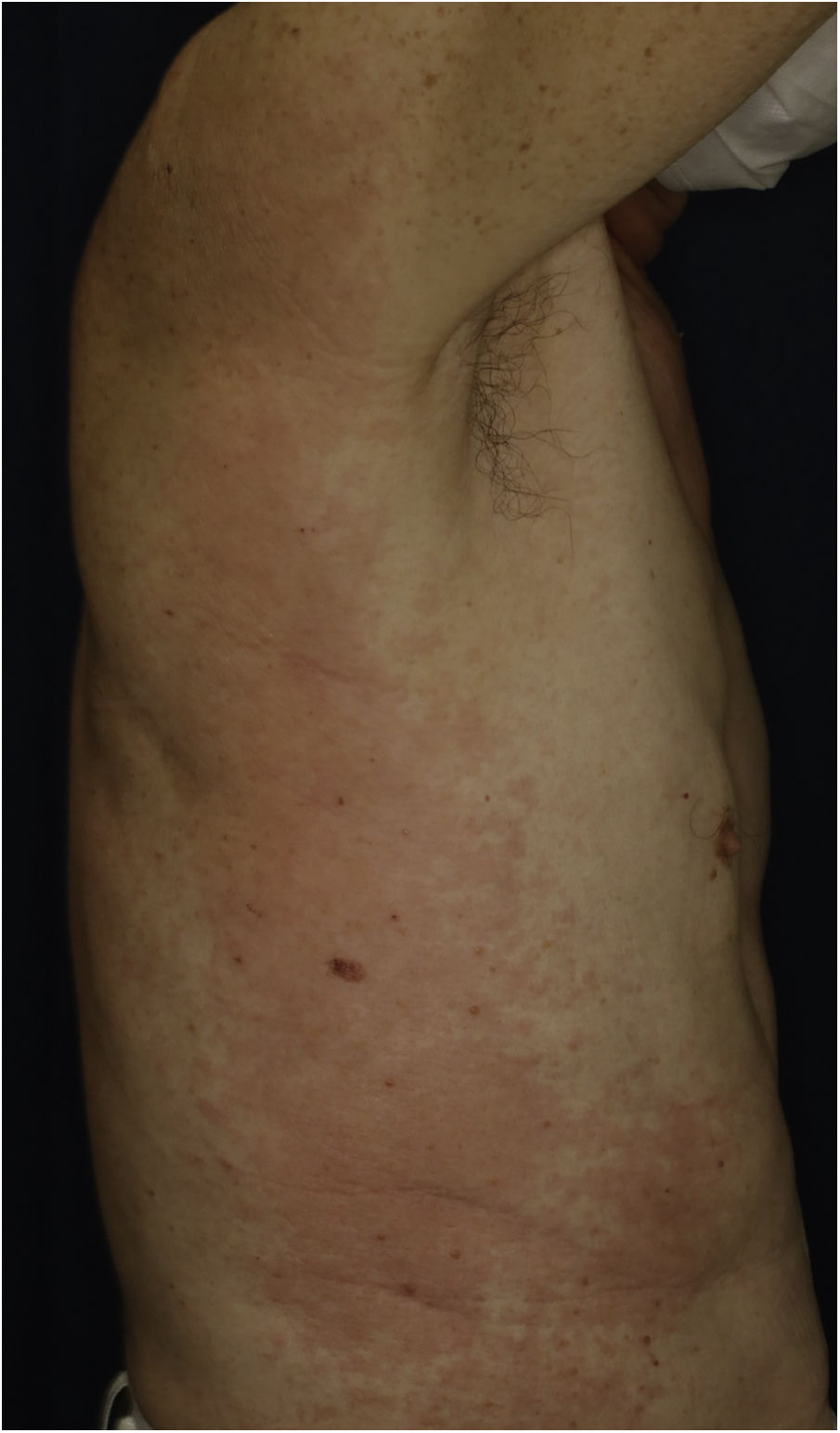 Psoriasiform rash following maculopapular eruption during the continued ...