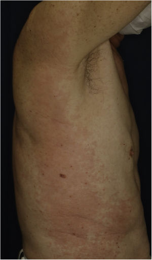 Diffuse coalescent erythema and paplular lesions on the trunk and extemities.