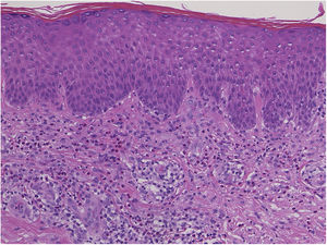 Histopathological features showing vacuolar degeneration of the basement membrane of the epidermis and cellular infiltration of mononuclear cells and eosinophils in the upper dermis.