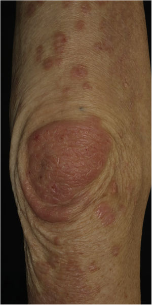 Well-defined keratotic erythema on the elbow.