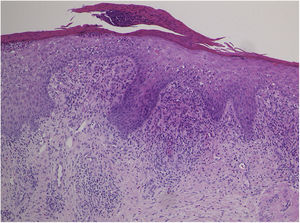 Histopathological features showing subcorneal microabcess, epidermal proliferation, scattered individual cell keratinization, and liquefaction degeneration in the basement membrane region.