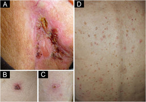 Erythematous plaque with a serous blister and crusted erosions in right laterocervical area (A). Crusted erosions localized in the lower abdomen (B) and pretibial area (C). Erythematous papules distributed over the patient