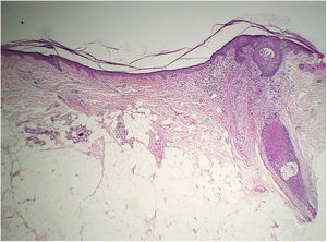 Anatomopathological examination of the skin showing significant dermal atrophy (Hematoxylin & eosin ×40).