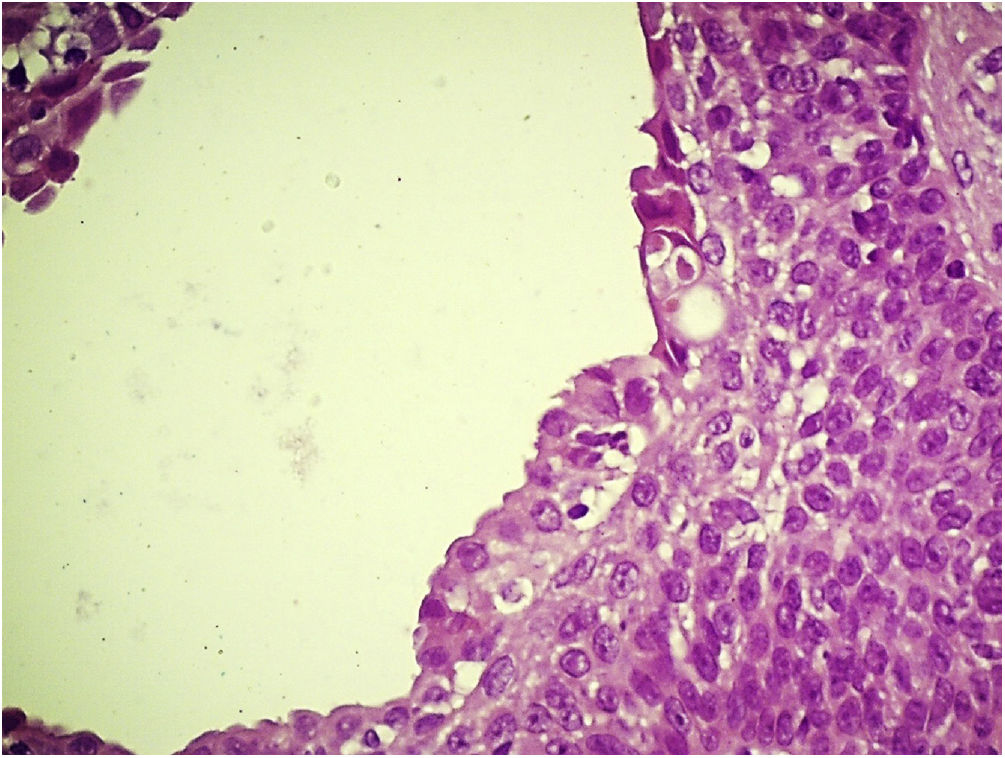 Apocorin Apocrine poroma: a case with multiple lesions | Anais Brasileiros de ...
