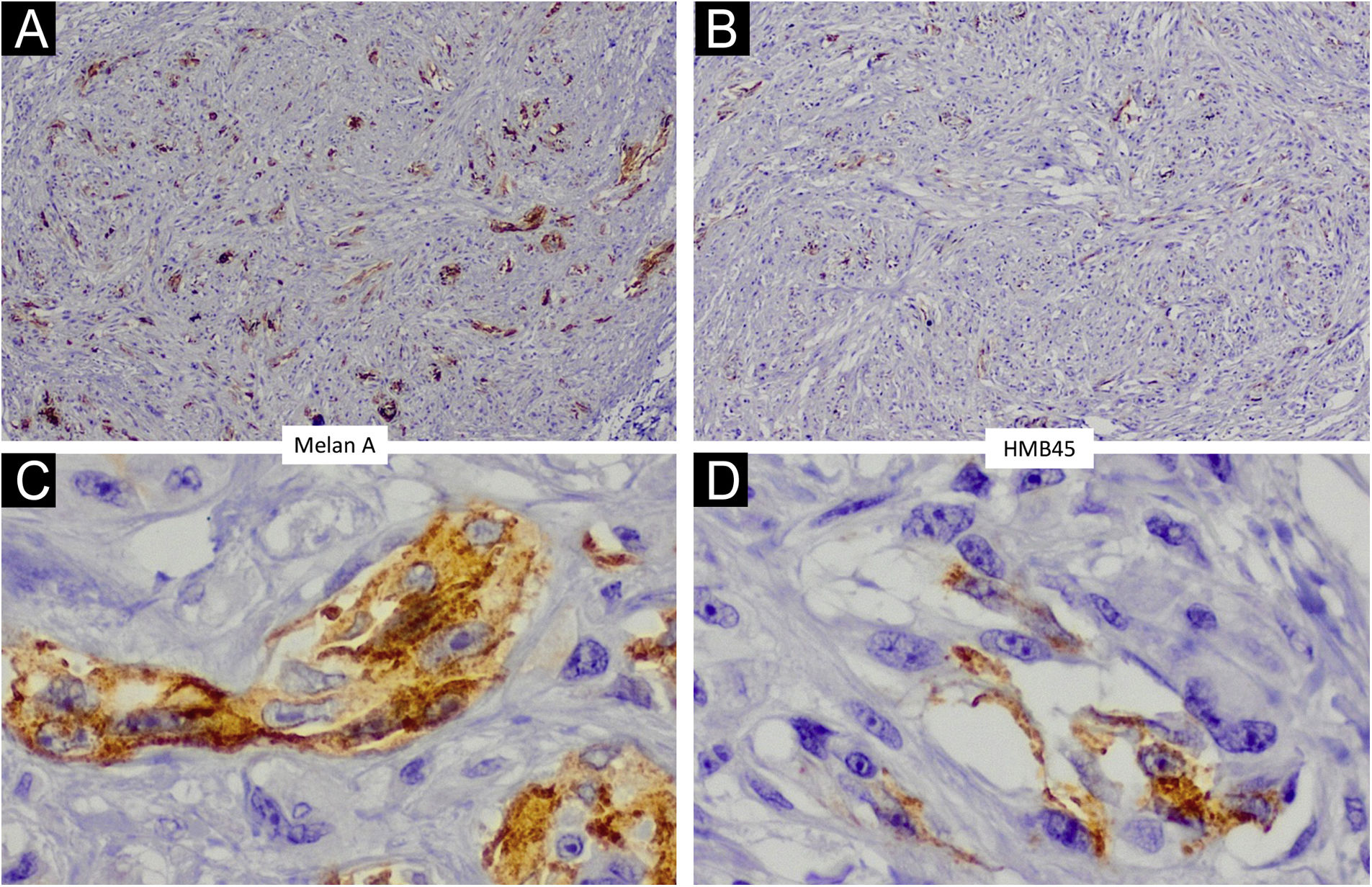 Vascularized parallel-ridge pattern: dermoscopic sign in acral melanoma ...