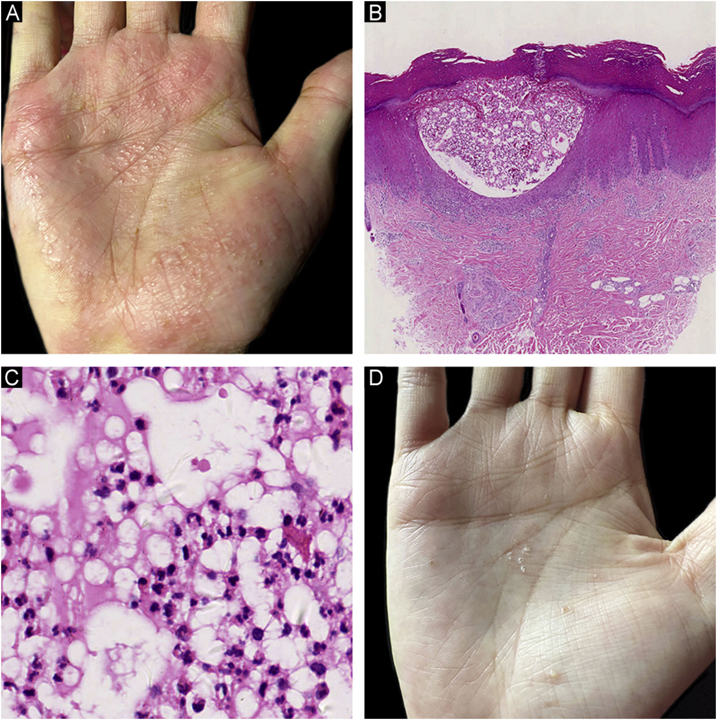 Pyoderma gangrenosum triggered by secukinumab in a patient with ...