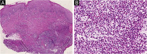 (A) A skin biopsy taken from the edge of the ulcer demonstrated diffuse inflammatory cells infiltrated throughout the whole dermis. (Hematoxylin & eosin, ×20); (B) Neutrophils represented the predominant infiltrating cells. (Hematoxylin & eosin, ×200).