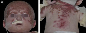 Child at four months of age showing in (A) exulcerations on the scalp and face and (B) exulcerations on the back and proximal region of the upper limbs.