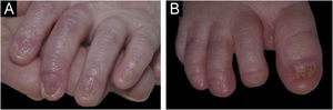 Nail changes in the newborn. Presence of onychodystrophy in all fingers (A) and all toes (B).