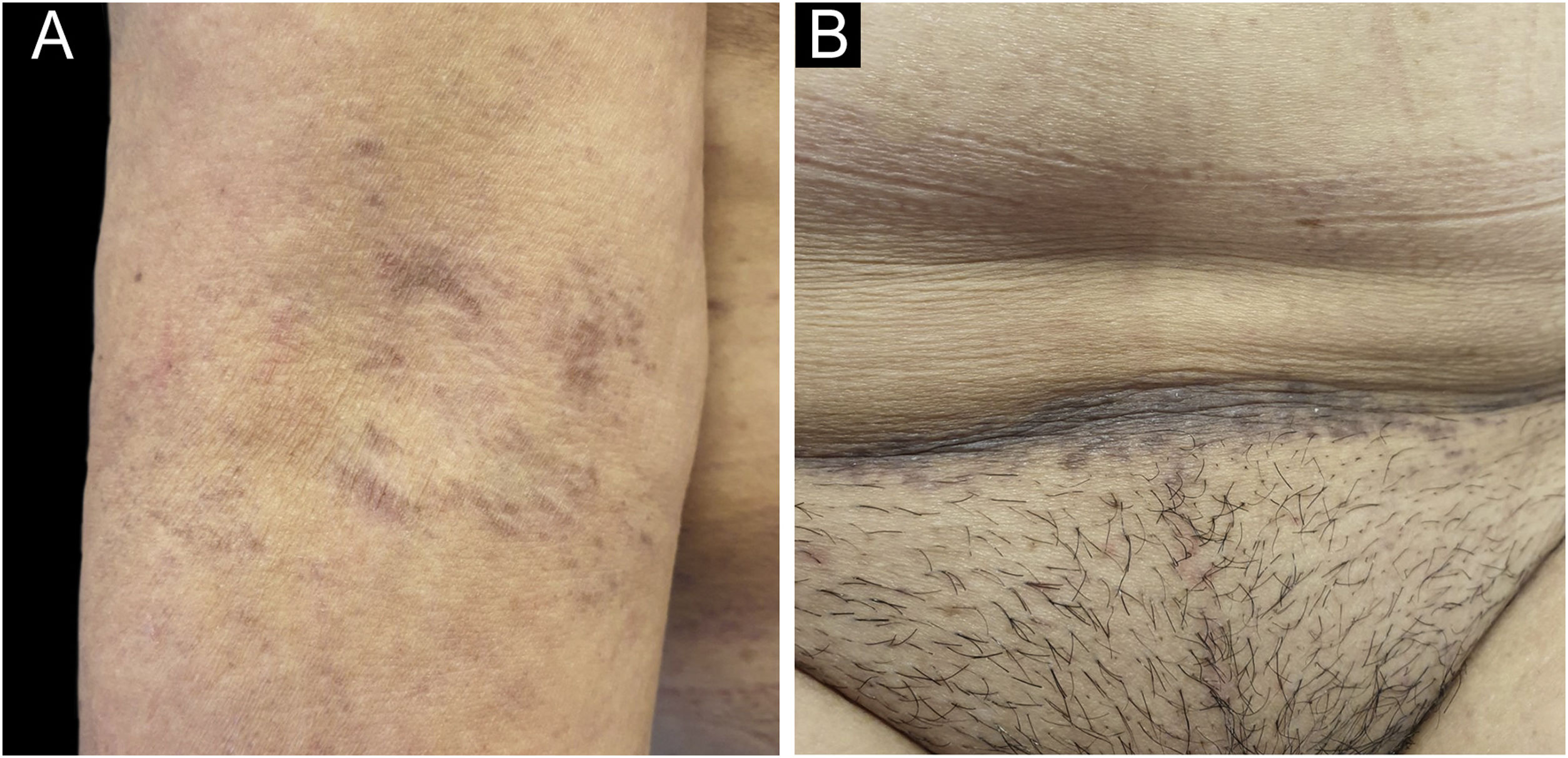 Abemaciclib induced Lichen Planus Pigmentosus Inversus Improving After abemaciclib-induced-lichen-planus-pigmentosus-inversus-improving-after