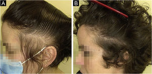 A case of traction alopecia due to a tight hairstyle, pre (A) and post (B) hair transplant.