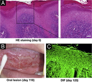 Clinical and pathological features of this patient. (A) Histopathological features for the biopsy of the right margin of tongue with white patch (Hematoxylin & eosin staining, scar bar=50μm). (B) Oral lesions. (C) Direct Immunofluorescence (DIF) showed positive intercellular staining of IgG.