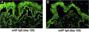 IIF using 1 M NaCl-split normal human skin (ssIIF) results of this patient serum. ssIIF showed both IgG (A) and IgA (B) staining in both epidermal and dermal sides.