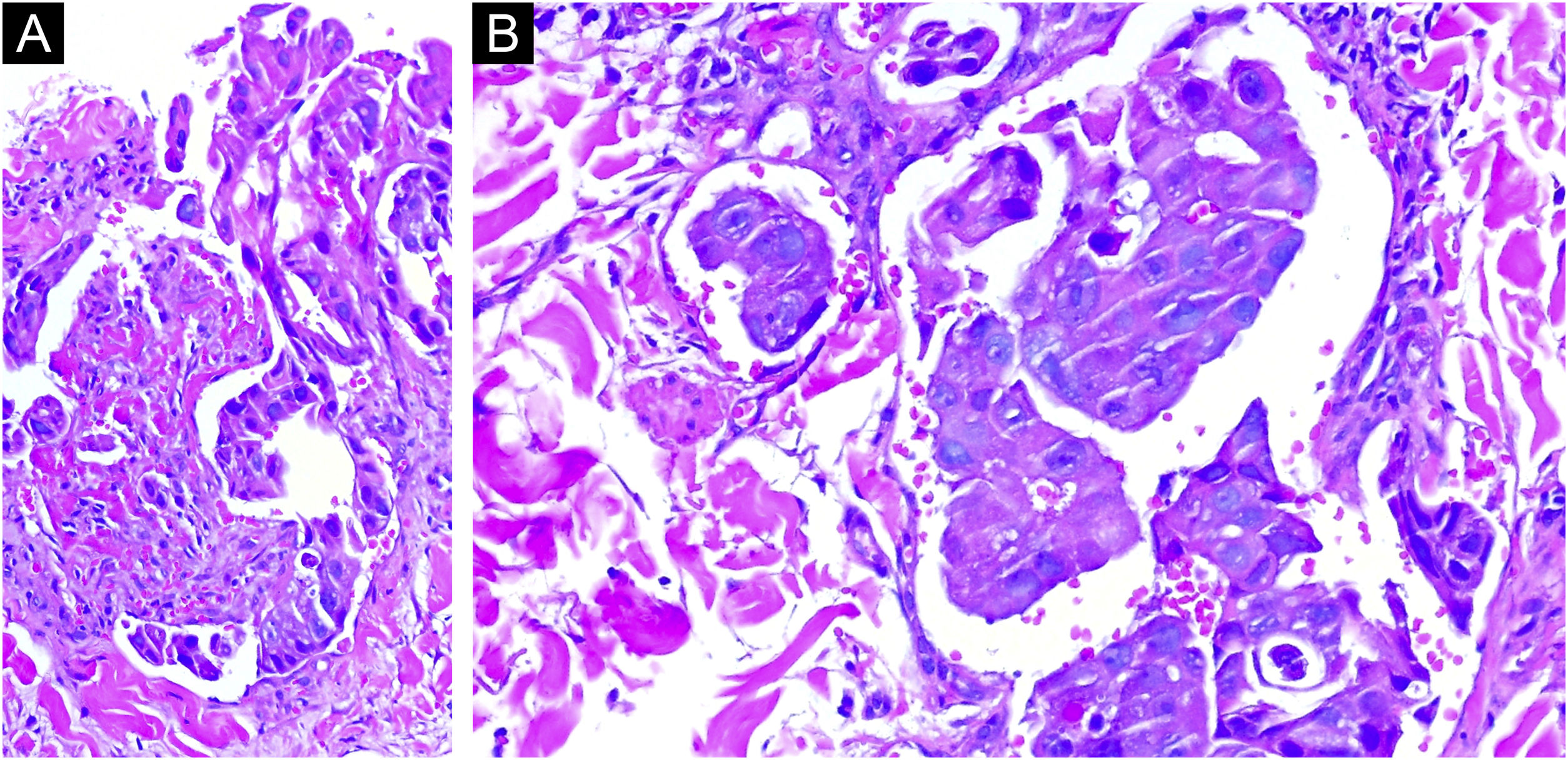 Zosteriform cutaneous metastases of HER-2 positive breast carcinoma ...