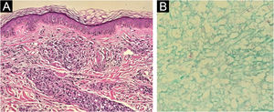 Histopathology of the region adjacent to the hypochromic spot seen in Figs. 2 and 3: on the left, the presence of a Grenz zone and poorly organised granulomatous infiltrate, containing many xanthomatous histiocytes (Hematoxylin & eosin, ×100); on the right, presence of intact bacilli organized in clusters (Fite-Faraco, ×40).