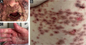 (A) Erosions on the labial mucosa and malar regions. (B) Palmar lesions. (C) Target-like lesions on the abdomen.